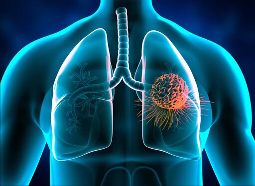 肺癌躍升為國癌！ 低劑量電腦斷層篩檢優缺一次報給你知！