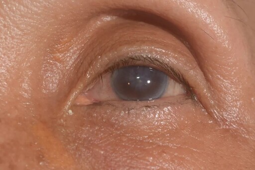 眼角膜水腫不必開大刀！角膜內皮細胞移植挽救失明風險！