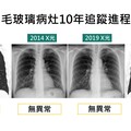 追蹤10年肺結節無異常 低劑量電能斷層揪出1.5公分腫瘤
