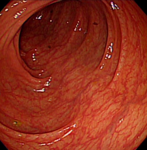 罕見FAP潛伏腸道 男子腸道長滿瘜肉 恐怖遺傳病忽略恐成癌