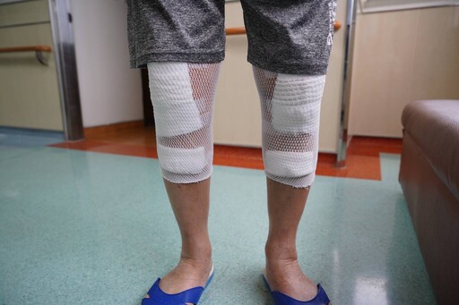 聖馬爾定醫院羅莎手術置換雙側膝關節 解決膝關節退化與長短腳