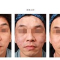 電動打脂槍臉部脂肪注射年輕化術 曹賜斌南韓分享美容醫療新亮點