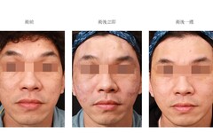 電動打脂槍臉部注射年輕化術 曹賜斌南韓分享美容醫療新亮點