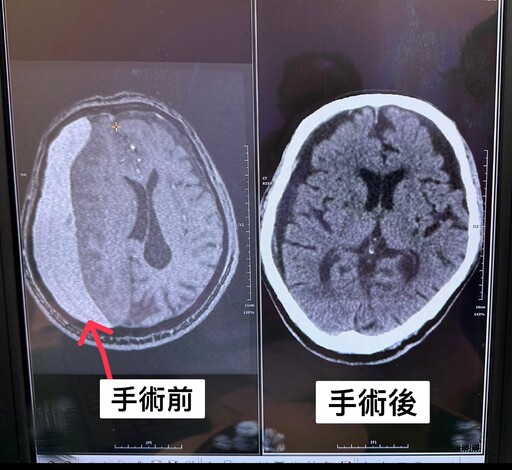 「慢性硬腦膜下腔出血」患者意識混亂 嘉榮醫揪出病症疑似失智症