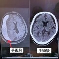 「慢性硬腦膜下腔出血」患者意識混亂 嘉榮醫揪出病症疑似失智症