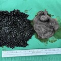 輕熟女大啖火鍋後喊腹痛 醫驚見「魚子醬」狀結石塞爆膽囊