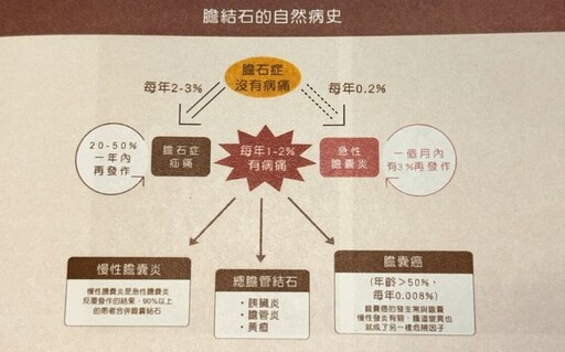 膽結石真會引發膽囊癌！全球罕見0.5%癌變機率 提醒民眾別忽視身體警訊