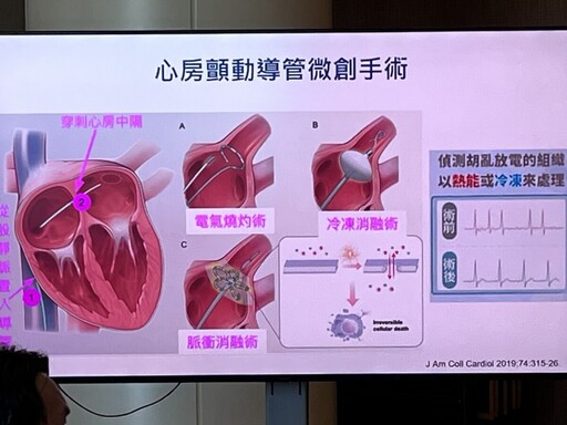可攜式AI人工智慧心律檢測儀揪出心律不整 嘉基與扶輪社合力推動公益篩檢