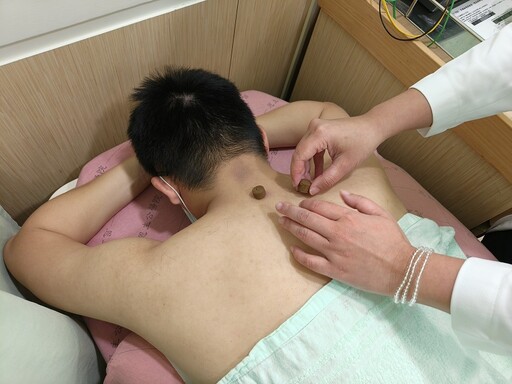拒當過敏兒!三伏貼「冬病夏治」助60歲婦人改善過敏性鼻炎
