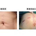 術後20公分蜈蚣疤壓垮8年人生 白疤之父曹賜斌神技助破繭重生
