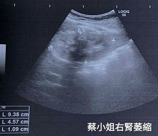 早發型糖尿病友血糖控制不良 醫師提醒：飲食調整和藥物配合有症狀盡快就醫