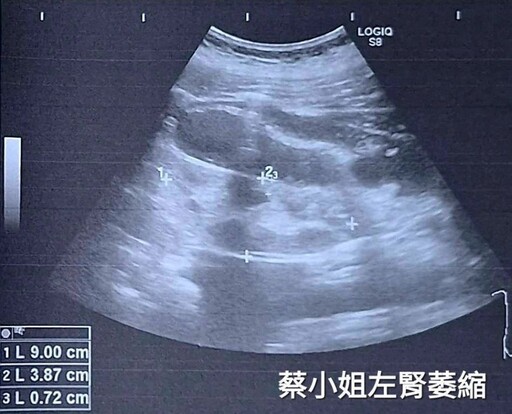 早發型糖尿病友血糖控制不良 醫師提醒：飲食調整和藥物配合有症狀盡快就醫
