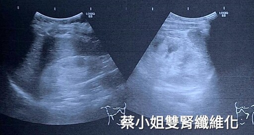 早發型糖尿病友血糖控制不良 醫師提醒：飲食調整和藥物配合有症狀盡快就醫