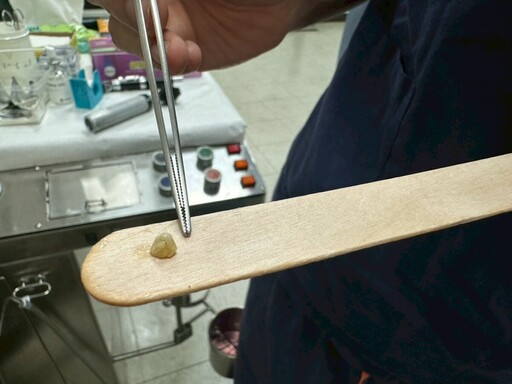 扁桃腺結石嘉榮耳鼻喉科成功處理 醫師提醒小症狀也不可忽視
