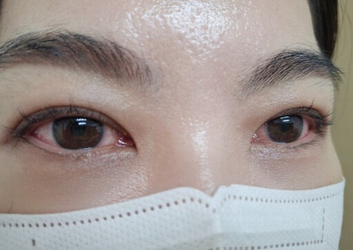 眼睛紅癢流淚別輕忽 恐是「急性結膜炎」找上門