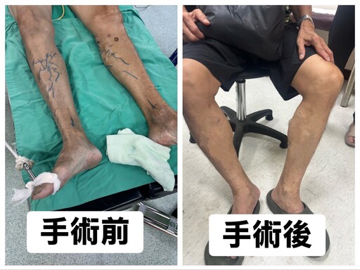 久站族容易罹患靜脈曲張 嘉榮雷射手術治療隔日就能下床行走