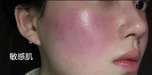 敏感肌、酒糟肌為何冬天大爆發?皮膚科醫師:別再怪冷空氣,熱水才是真正元凶!
