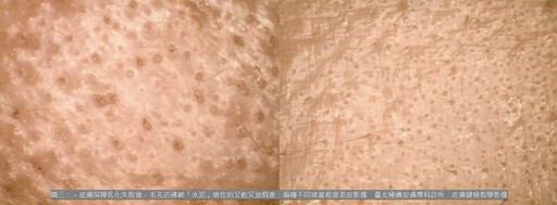 敏感肌、酒糟肌為何冬天大爆發?皮膚科醫師:別再怪冷空氣,熱水才是真正元凶!