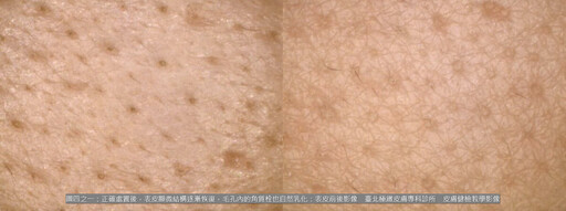 敏感肌、酒糟肌為何冬天大爆發?皮膚科醫師:別再怪冷空氣,熱水才是真正元凶!