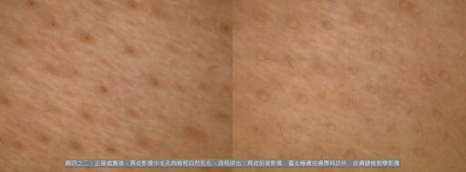 敏感肌、酒糟肌為何冬天大爆發?皮膚科醫師:別再怪冷空氣,熱水才是真正元凶!