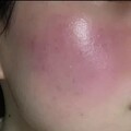 敏感肌、酒糟肌為何冬天大爆發？皮膚科醫師：別再怪冷空氣，熱水才是真正元凶！