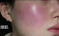 敏感肌、酒糟肌為何冬天大爆發？皮膚科醫師：別再怪冷空氣，熱水才是真正元凶！