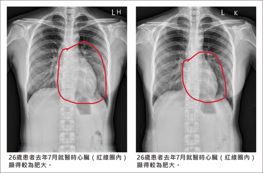 甲亢引發心臟衰竭 規律服藥10月痊癒重回健康