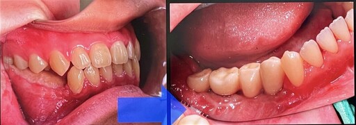 罕見牙骨質骨化纖維瘤切除 三年手術重建下顎