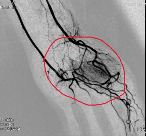 車禍肩痛拖半年 微導管栓塞術助男終於不再痛醒
