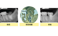 智齒移植至左下缺牙 術後如願恢復咀嚼功能