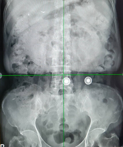北榮桃分院提醒X光檢查 多一個步驟、多一份安心
