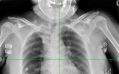 北榮桃分院提醒X光檢查 多一個步驟、多一份安心