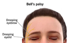 顏面神經麻痺來得快如閃電 醫：儘早就醫掌握最佳治療時間