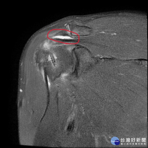 男肩膀痛到睡不著兩度手術才緩解 醫師：長期搬重物、游泳、棒球投手都要注意