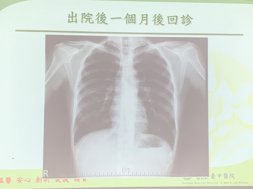 台日混血女大生返日探親 回台熬夜追劇感染嚴重黴漿菌肺炎