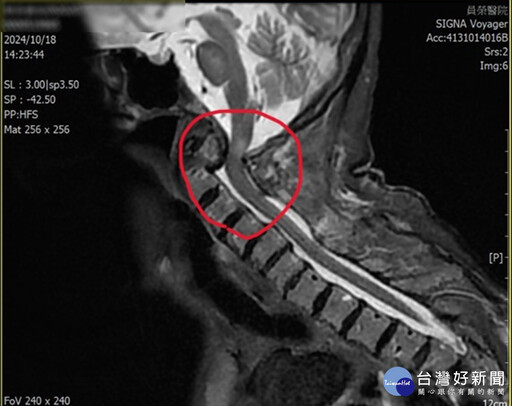 跌倒頸椎骨折被誤認帕金斯症 員榮神內外醫師聯手診治助七旬婦人