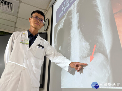 鼻胃管竟在胃裡打結 醫師這樣做順利拔管恢復正常進食