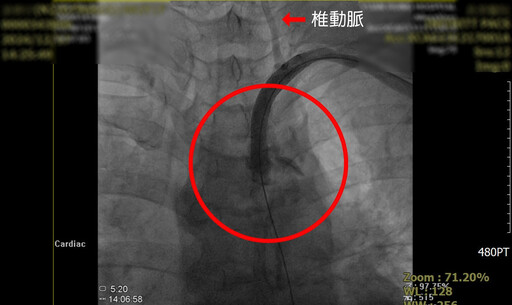 中年女子頭暈多年 手愈動頭愈晕 竟是患罕見「鎖骨下動脈竊血症候群」