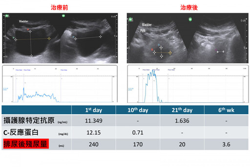 重症肌無力竟「尿」出危機 醫：排尿藥物使用需慎評，避免誘發呼吸衰竭