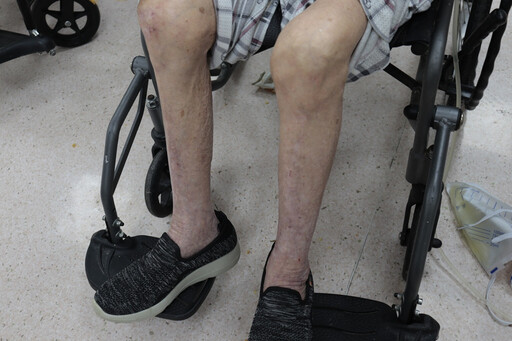 走路常跌並非骨鬆？ 75歲嬤驚見「肌少症」藏危機