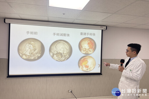 車禍重創腦部 佳里奇美醫療團隊運用3D科技助重生