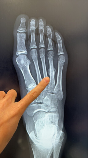 小朋友運動「過度」後腳痛別輕忽 醫：恐是「應力性骨折」警訊