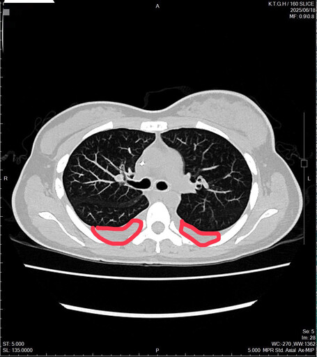 女社畜長期輪大夜班作息亂 乳房小腫塊拖半年確診乳癌第四期