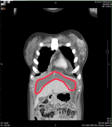 女社畜長期輪大夜班作息亂 乳房小腫塊拖半年確診乳癌第四期