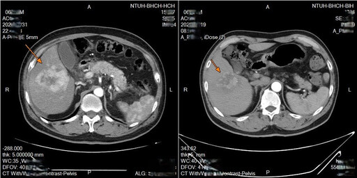 改良肝動脈內灌注化療技術 提升中晚期肝癌精準治療