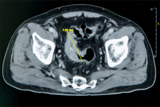 雲林七旬翁腹脹就醫 彰基達文西SP單孔手術助快速康復