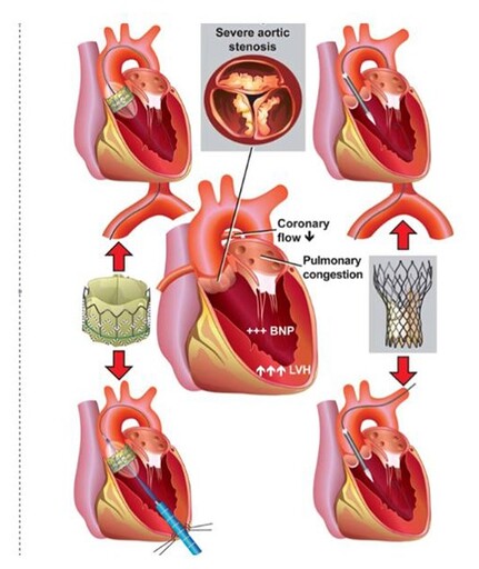 主動脈瓣膜狹窄恐心臟衰竭！經導管主動脈瓣膜置換術新選擇