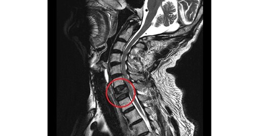 肩頸痠痛竟是頸椎長腫瘤，釀爆裂骨折惹禍！新式撐開型支架術解救