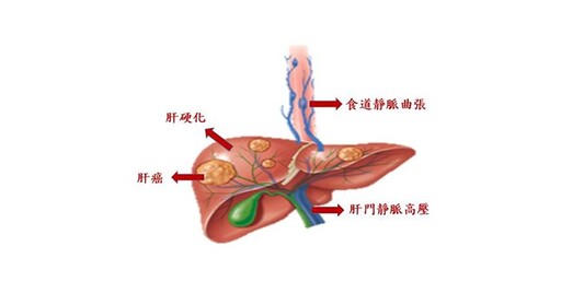 肝癌併食道靜脈曲張新解方！內視鏡結紮減少出血，提升早期肝癌存活率