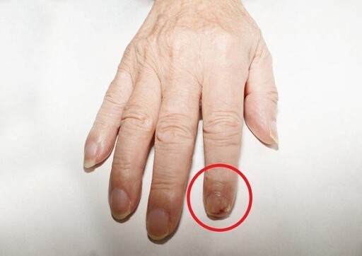 指甲紅腫疼痛，傷口老是好不了？小心可能是甲床鱗狀細胞癌
